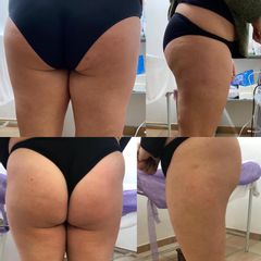 Cellulite - Dott.ssa Maria Gaetana Basile