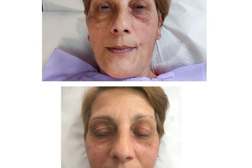 Peeling chimico prima e dopo - 816505