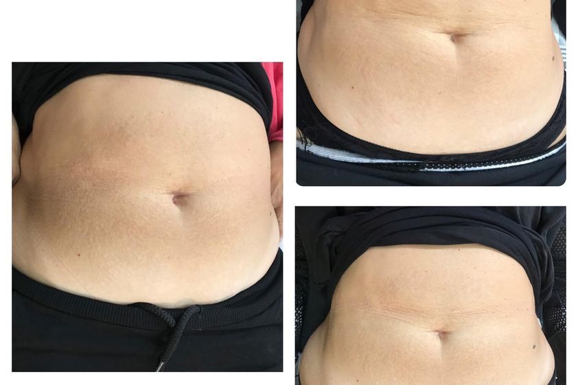 Mesoterapia prima e dopo - 816506