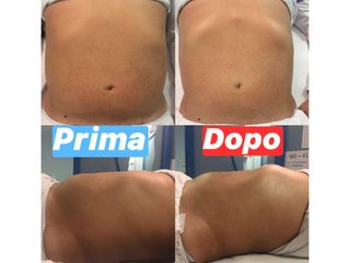 radiofrequenza prima dopo