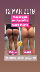 Cellulite prima dopo