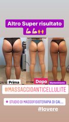 Cellulite prima dopo