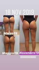 Cellulite prima dopo