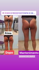 Cellulite prima dopo