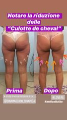 Cellulite prima dopo