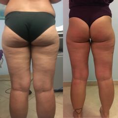 Cellulite prima dopo