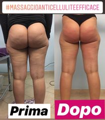 Cellulite prima dopo