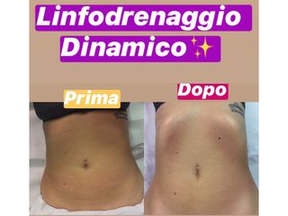 Linfodrenaggio dinamico prima dopo