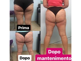 Cellulite prima dopo
