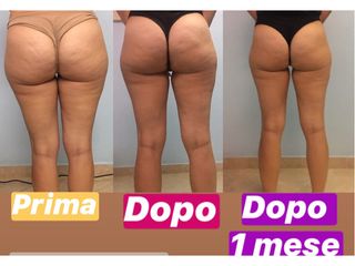 Cellulite prima dopo