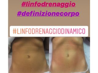 Linfodrenaggio dinamico prima dopo