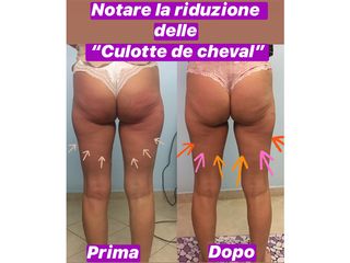 Cellulite prima dopo