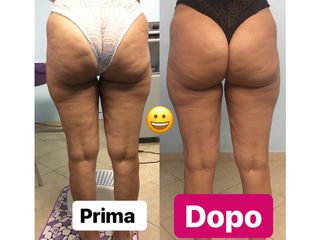 Cellulite prima dopo
