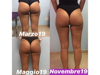 Cellulite prima dopo