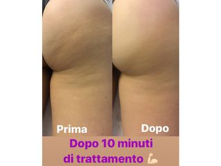 Cellulite prima dopo