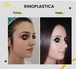 Rinoplastica - Poliambulatorio Med360