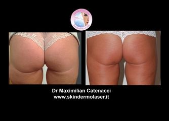 Cellulite prima dopo
