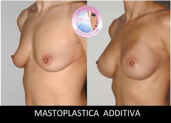 mastoplastica additiva prima dopo