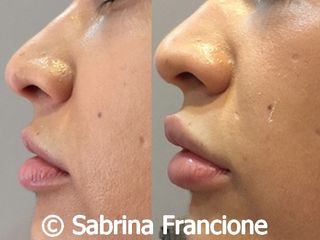 Filler labbra prima e dopo