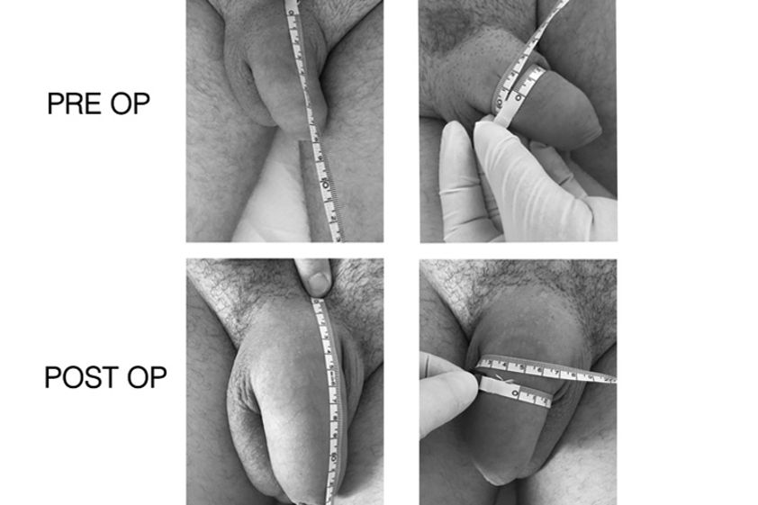 Ingrossamento pene prima e dopo - 770174