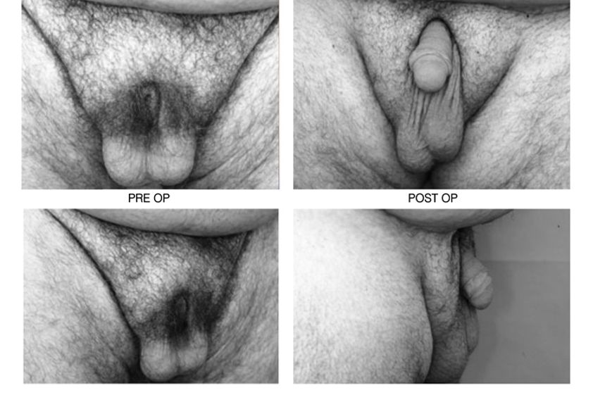 Allungamento pene prima e dopo - 770177