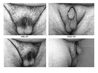allungamento pene prima e dopo