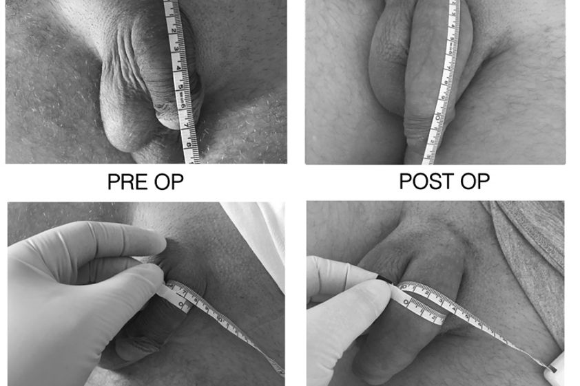 Allungamento pene prima e dopo - 770178