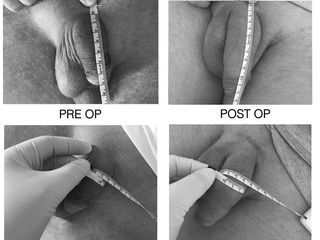 allungamento pene prima e dopo