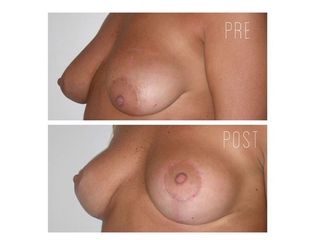 mastopessi pre e post