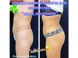 Liposuzione prima e dopo