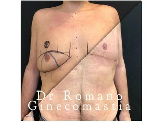 Ginecomastia prima e dopo
