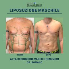 Liposuzione Maschile con metodo Renuvion