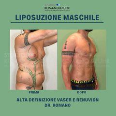 Liposuzione Maschile con metodo Renuvion