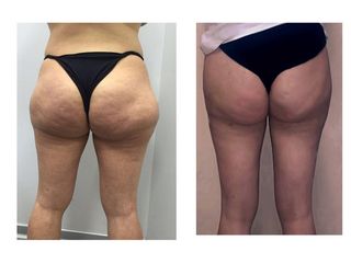 liposcultura prima dopo