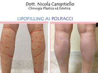 Lipofilling polpacci prima dopo