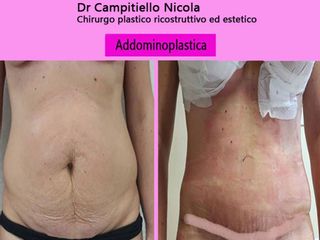 Addominoplastica prima dopo