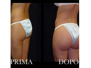 Gluteoplastica prima e dopo