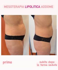 Mesoterapia - Dottoressa Serafina Ghianda