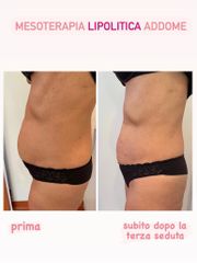 Mesoterapia - Dottoressa Serafina Ghianda