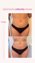 Mesoterapia - Dottoressa Serafina Ghianda