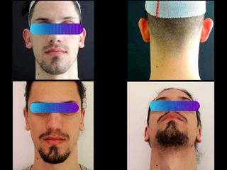 Otoplastica - Physiomed