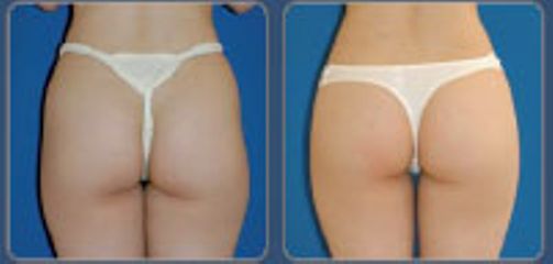 Rimodellamento corpo LESC