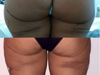 Rimodellamento corpo LESC