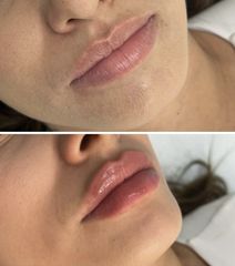 Filler labbra - Dott. Miro De Luca