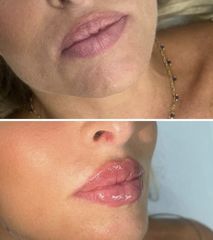 Filler labbra - Dott. Miro De Luca