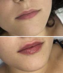 Filler labbra - Dott. Miro De Luca
