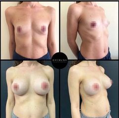 Mastoplastica additiva - Dott. Cristiano Biagi - Excelsa Aesthetic Medicine
