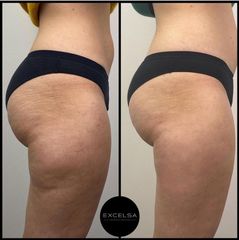 Liposuzione - Excelsa Aesthetic Medicine