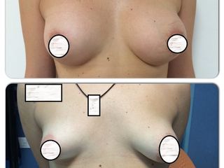 Mammella tuberosa pre e post