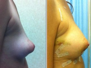 Mammella tuberosa e lipofilling